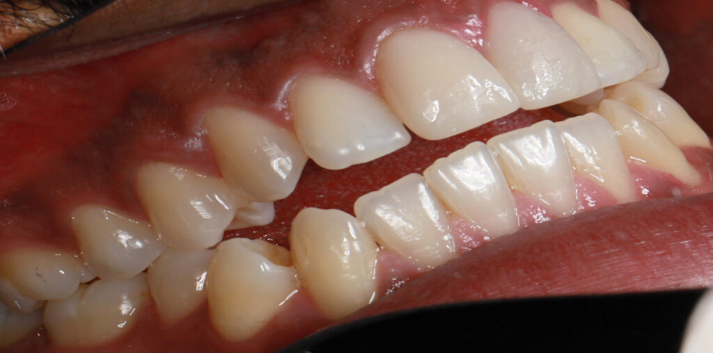 AFTER-4-MONTH-LEFT-SIDE12-3-resize