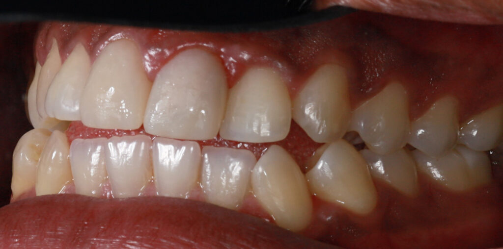 AFTER-4-MONTH-RIGHT SIDE12-2-crowns(#8,#9)-resize